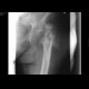 Hip replacement, osteomyelitis, fistula of hip joint: X-ray - Plain radiograph